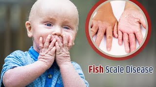 genetic disease ichthyosis vulgaris treatment videos fish scale disease treatment [upl. by Gordon52]