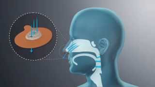 Provent Therapy An Alternative to CPAP for Sleep Apnea  DirectHomeMedicalcom [upl. by Lemuel378]