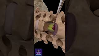 Anterior Cervical Discectomy amp Fusion shorts [upl. by Aham817]