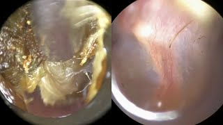 134  Extreme Ear Wax Blockage Removal From Tender Ear using WAXscope®️ [upl. by Beberg]