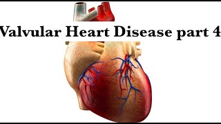 Valvular Heart Disease part 4Aortic amp pulmonary Stenosis and regurge by ASM Minds Team [upl. by Innad]