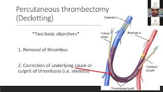 Advancements in Dialysis Declotting AV Thrombectomy and the use of CLEANER [upl. by Tam]