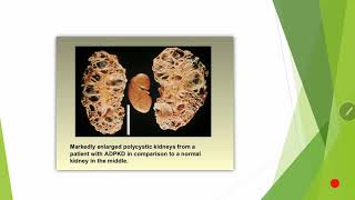 cystic kidney disease [upl. by Diana311]