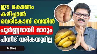 ഈ ഭക്ഷണങ്ങൾ കഴിച്ചു വെരികോസ് വെയ്ൻ പൂർണമായി മാറ്റം Vericose Treatment in Malayalam  Dr Shimji [upl. by Nnail]