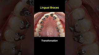 Lingual braces transformation braces orthodontist bracket [upl. by Harragan]