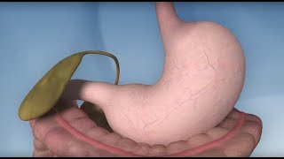 Gastric Bypass Complications  Mayo Clinic [upl. by Durr]