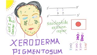 Xeroderma Pigmentosum [upl. by Einnij]