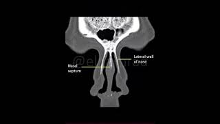 Coronal CT section of nose and paranasal sinuses [upl. by Adnirolc145]