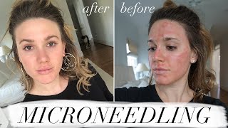 MY FIRST MICRONEEDLING EXPERIENCE amp WHAT TO EXPECT ACNE SCAR TREATMENT [upl. by Neros]