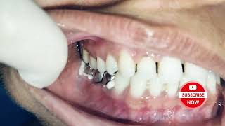 Cementation of Bridge 454647 painless dentist [upl. by Warde]