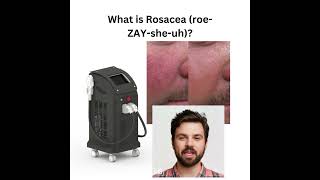 What is Rosacea [upl. by Stokes]