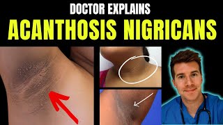 Doctor explains Acanthosis Nigricans  signs symptoms causes treatment and more [upl. by Frayne490]