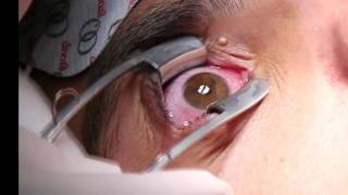 Corneal Iontophoresis Procedure [upl. by Akahs]