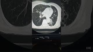 Bilateral bronchiectasis on CT scan CT scan chest interpretation [upl. by Meuse]