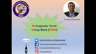 PENG block  Pericapsular Nerve Group Block [upl. by Eilsel703]