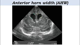 Radiology case 10   Neonatal Germinal matrix hemorrhage  cranial ultrasound DrMohamed soliman [upl. by Zechariah938]