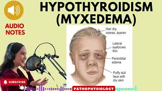 Hypothyroidism Myxedema Causes SignsSymptoms amp treatment [upl. by Nicolas]