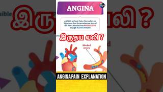 angina Pain  shorts [upl. by Shu]