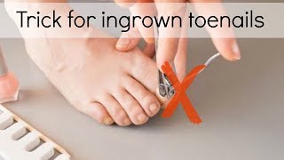 How to Fix Ingrown Toenails Easily [upl. by Nwadahs284]