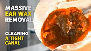 Clearing a Tight Ear Canal of Massive Ear Wax [upl. by Eehtomit]