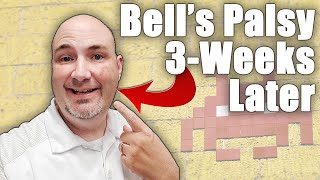 3Weeks Post Bells Palsy Diagnosis Update  Our Path Towards Recovery [upl. by Butterworth]