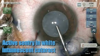 Active sentry in white intumescent cataract using very low IOP [upl. by Zolner]