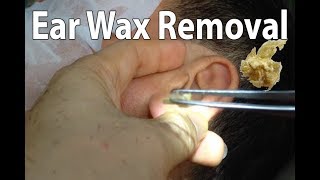 Ear Wax Removal 2019 [upl. by Aninaj]