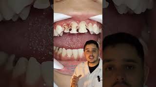 UM ALERTA PARA TODOS OS PAIS 🚨 alerta chocante carie dentes dentista [upl. by Atthia]