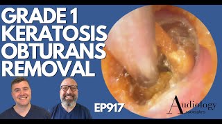 GRADE 1 KERATOSIS OBTURANS REMOVAL  EP917 [upl. by Ivon]