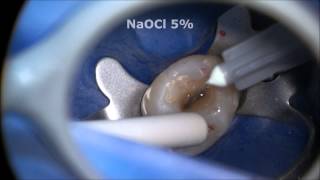 Endodontic Access and Root Canal Preparation explained [upl. by Renrut]