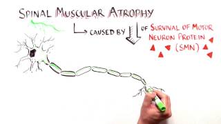 Cut and Paste Treating Spinal Muscular Atrophy with Nusinersen [upl. by Stannwood]