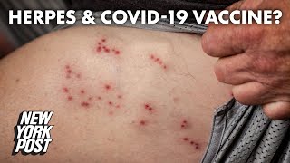 Herpes infection possibly linked to COVID19 vaccine  New York Post [upl. by Warde958]