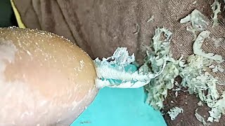 Foot scraping dead skinampcallus removal 【Yue Yidao】 [upl. by Yelkcub842]