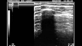 Normal lung vs pneumothorax [upl. by Nerrej]