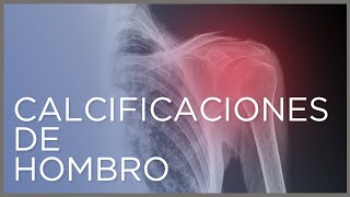 Calcificaciones de hombro qué es y cómo se tratan [upl. by Coulter849]