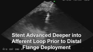 Endoscopic Management of Afferent Loop Syndrome Using a Lumen Apposing Metal Stent [upl. by Tarton498]