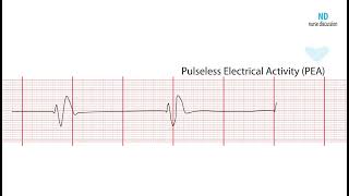 Pulseless Electrical Activity PEA ECG Review Learn the Heart [upl. by Bouton]