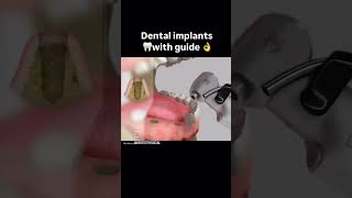 Dental Implant dental dentist dentistdoctor dentistry medicaldoctor smiledental shortvideo [upl. by Aizatsana]