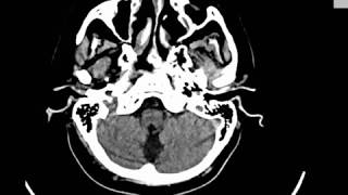 CASE 348 CT BRAIN LACUNAR AND BASAL GANGLIA INFARCTION ATROPHIC CHANGES [upl. by Hertzfeld]