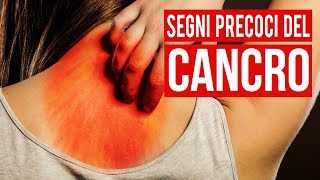 10 Segni Precoci Del Cancro Che La Maggior Parte Delle Persone Ignora [upl. by Ilram279]