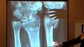 Distal radius cases  dr Aaron Gans techniques [upl. by Penland]