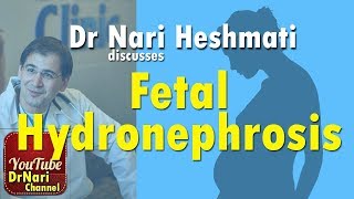 Fetal Hydronephrosis also known as pyelectasis or pelviectasis Discussed by Dr Nari Heshmati [upl. by Tut]