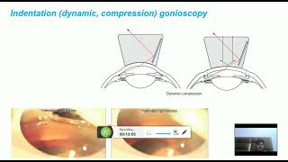 Direct and indirect gonioscopy grading systems ie shaffer scheie and spaeth [upl. by Laucsap225]