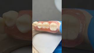 Unilateral Molar Partial ​⁠EnvisiontecMain envisiontec lsk121shorts dentist teeth [upl. by Ettennan]