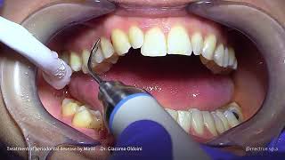 PROPHYLAXIS Dr Giacomo Oldoini  Treatment of Periodontal Disease by Minst [upl. by Llerdnad]