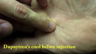 Xiaflex collagenase injection for Dupuytrens Finger Contracture [upl. by Ahsilyt319]