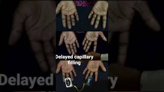 Demonstration of delayed capillary refilling [upl. by Llehctim]