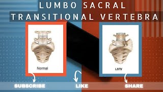 LUMBOSACRAL TRANSITIONAL VERTEBRAE  LSTV  LUMBARIZATION  SACRALIZATION  BERTOLOTTI SYNDROME [upl. by Mastrianni]