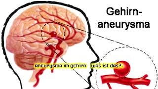 Aneurysma im Gehirn – Was ist das [upl. by Edac68]