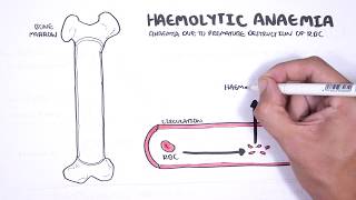 Haemolytic Anaemia  classification intravascular extravascular pathophysiology investigations [upl. by Ettegdirb]